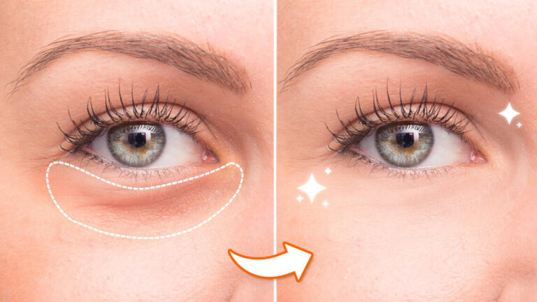 How to get rid of dark circles under eyes naturally at home