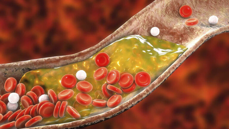 If cholesterol in the body reaches this level a heart attack can occur